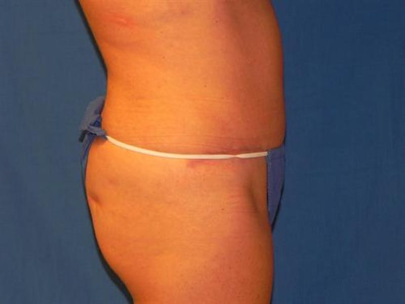 Tummy Tuck Before & After Gallery - Patient 358683 - Image 4