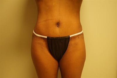 Tummy Tuck Before & After Gallery - Patient 312869 - Image 2