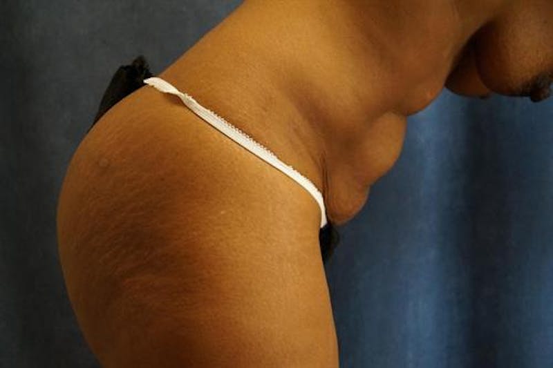 Tummy Tuck Before & After Gallery - Patient 312869 - Image 5