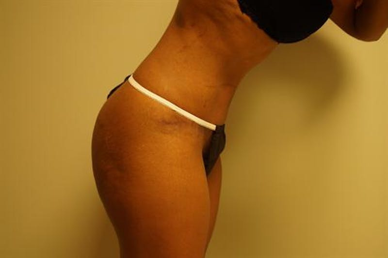Tummy Tuck Before & After Gallery - Patient 312869 - Image 6