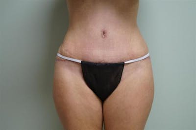 Tummy Tuck Before & After Gallery - Patient 152999 - Image 2