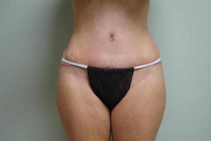 Tummy Tuck Before & After Gallery - Patient 152999 - Image 2