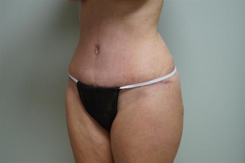 Tummy Tuck Before & After Gallery - Patient 152999 - Image 4