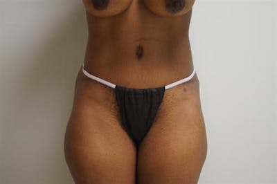 Tummy Tuck Before & After Gallery - Patient 796387 - Image 2
