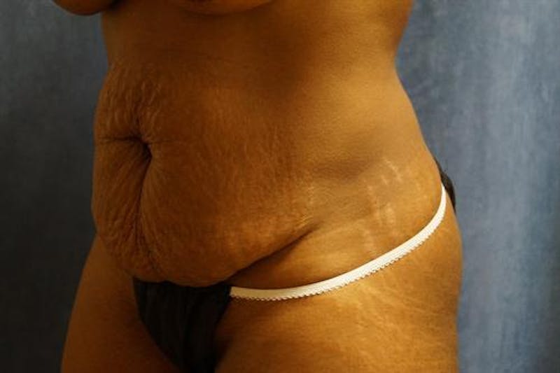 Tummy Tuck Before & After Gallery - Patient 796387 - Image 5