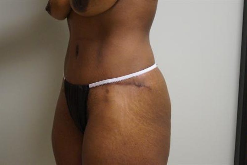 Tummy Tuck Before & After Gallery - Patient 796387 - Image 6