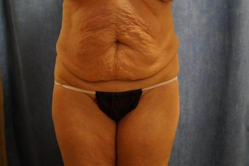 Tummy Tuck Before & After Gallery - Patient 288389 - Image 1