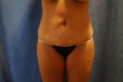 Tummy Tuck Before & After Gallery - Patient 239563 - Image 1
