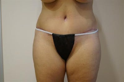 Tummy Tuck Before & After Gallery - Patient 239563 - Image 2