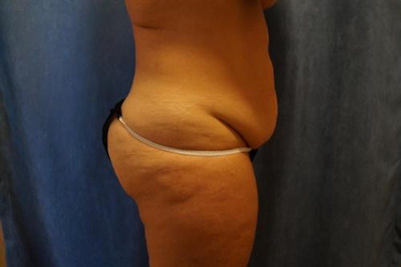 Tummy Tuck Before & After Gallery - Patient 239563 - Image 3