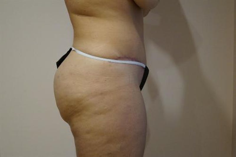 Tummy Tuck Before & After Gallery - Patient 239563 - Image 4