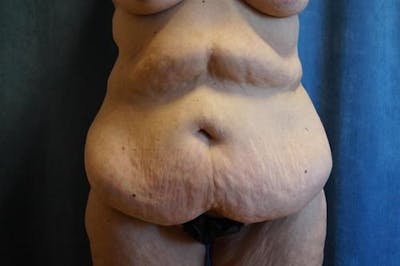 Tummy Tuck Before & After Gallery - Patient 569268 - Image 1