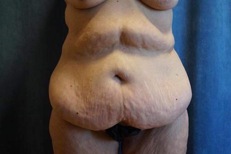 Tummy Tuck Before & After Gallery - Patient 569268 - Image 1