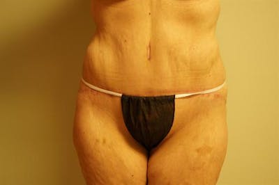 Tummy Tuck Before & After Gallery - Patient 569268 - Image 2
