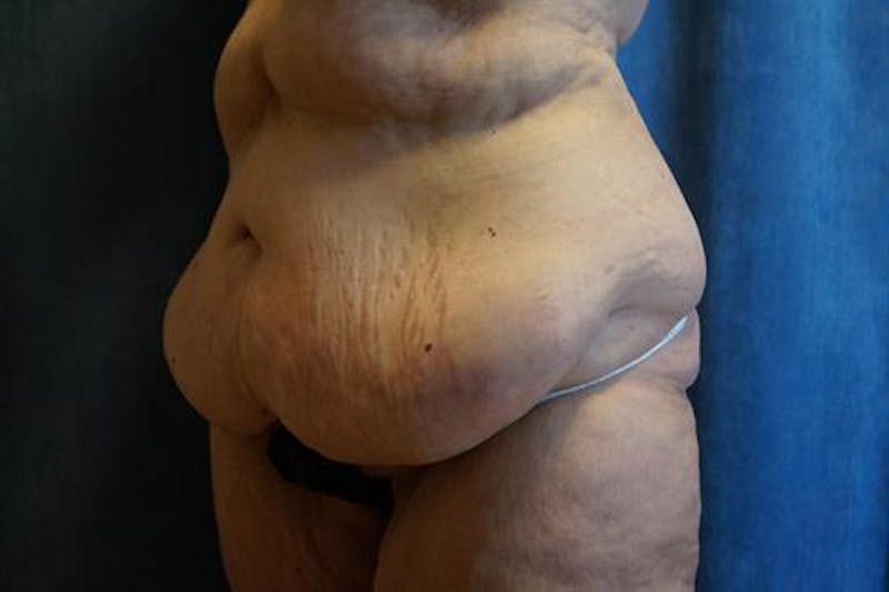 Tummy Tuck Before & After Gallery - Patient 569268 - Image 3