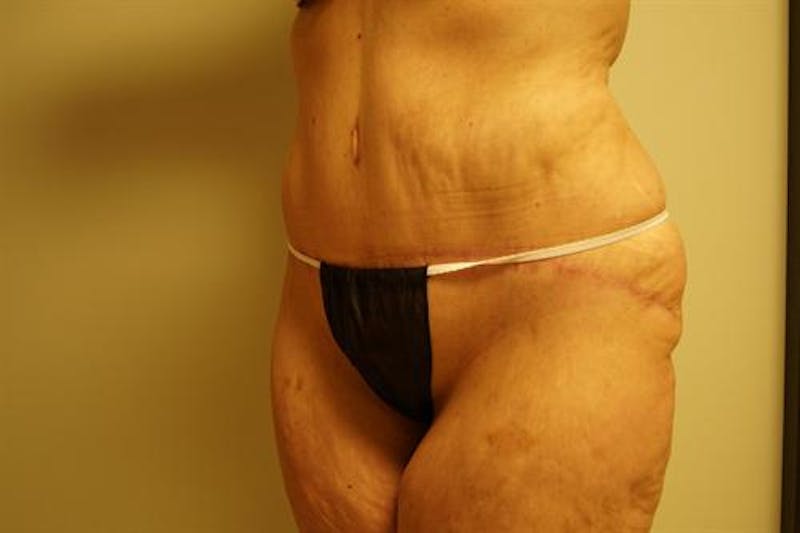 Tummy Tuck Before & After Gallery - Patient 569268 - Image 4