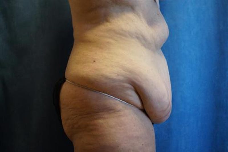 Tummy Tuck Before & After Gallery - Patient 569268 - Image 5