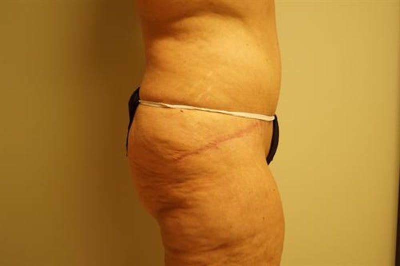 Tummy Tuck Before & After Gallery - Patient 569268 - Image 6