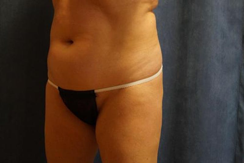 Tummy Tuck Before & After Gallery - Patient 168794 - Image 3