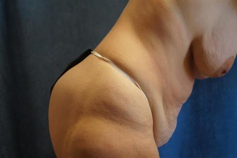 Tummy Tuck Before & After Gallery - Patient 428898 - Image 3