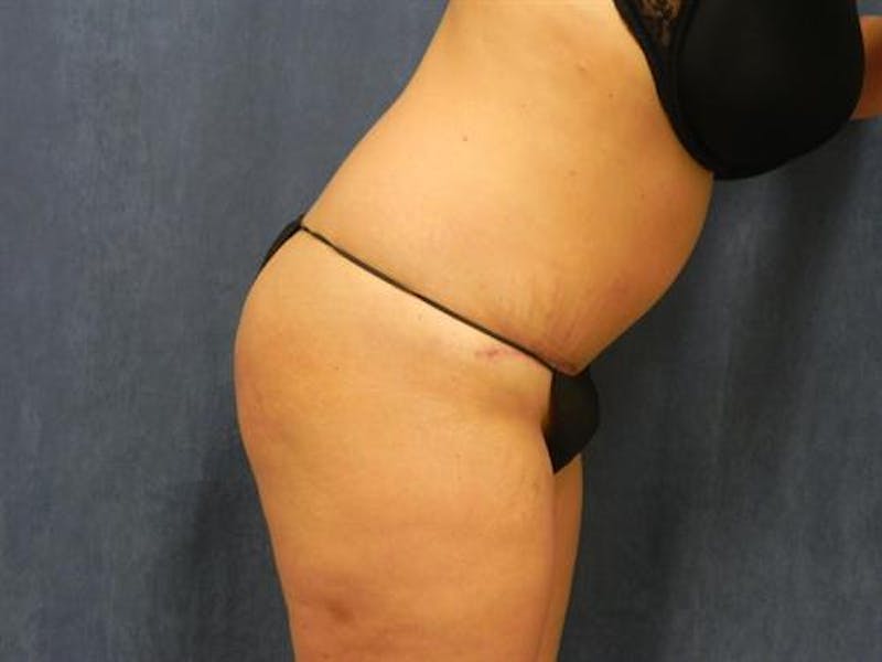 Tummy Tuck Before & After Gallery - Patient 428898 - Image 4