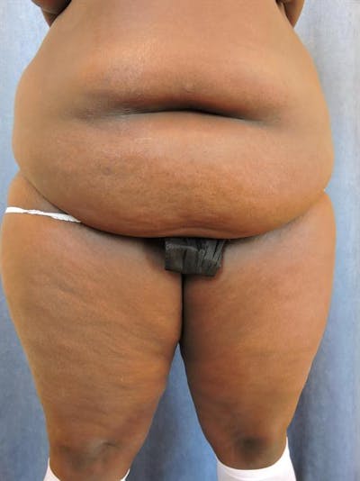 Tummy Tuck Before & After Gallery - Patient 202816 - Image 1