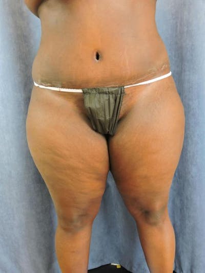 Tummy Tuck Before & After Gallery - Patient 202816 - Image 2