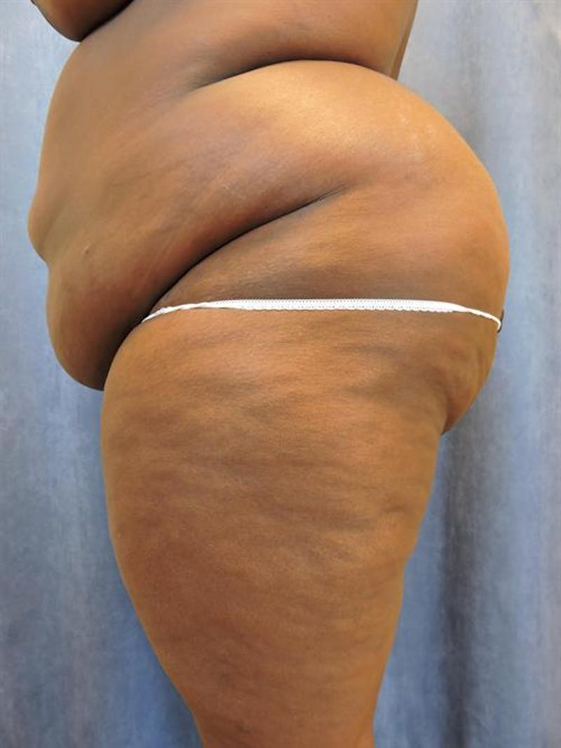 Tummy Tuck Before & After Gallery - Patient 202816 - Image 3