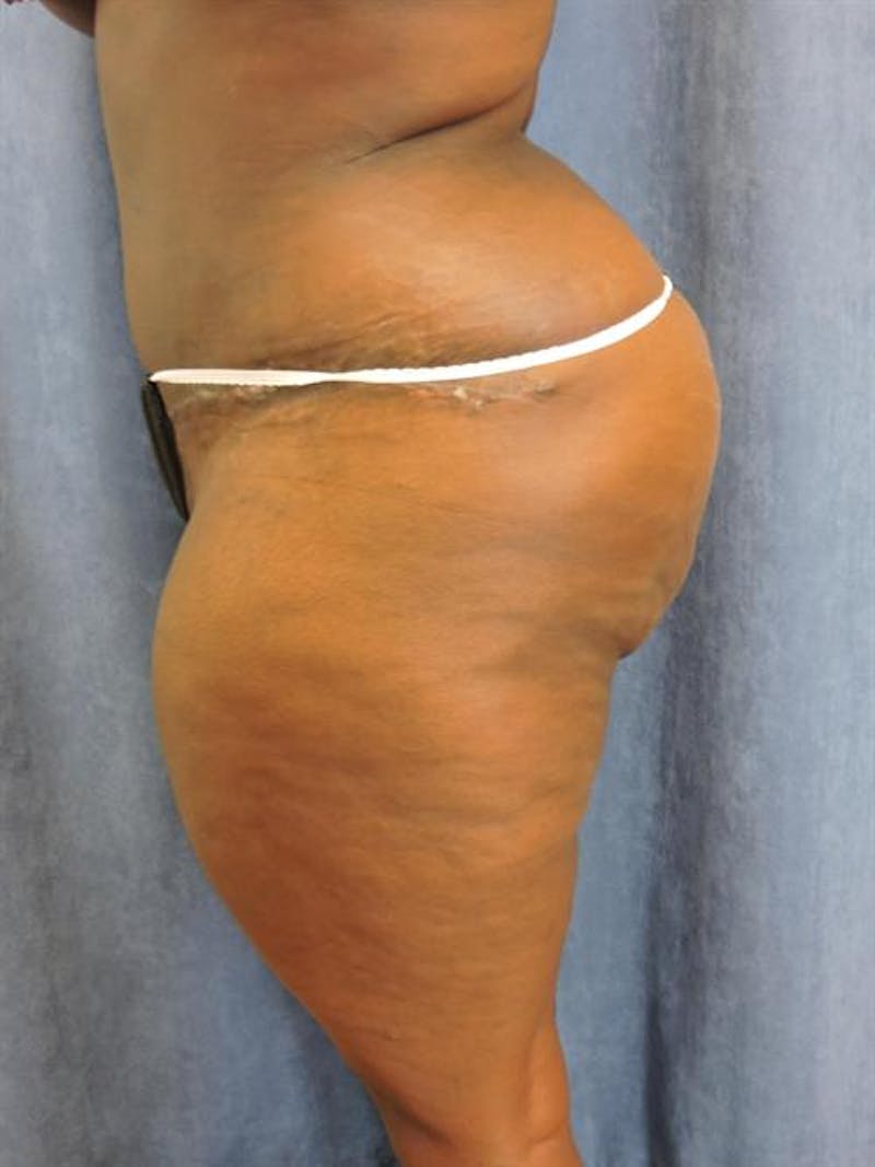 Tummy Tuck Before & After Gallery - Patient 202816 - Image 4