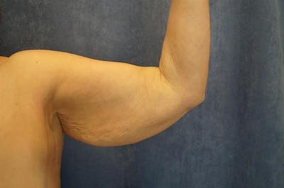 Plastic Surgery After Weight Loss Before & After Gallery - Patient 258843 - Image 1