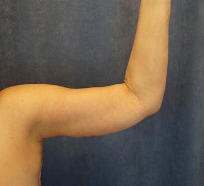 Plastic Surgery After Weight Loss Before & After Gallery - Patient 258843 - Image 2