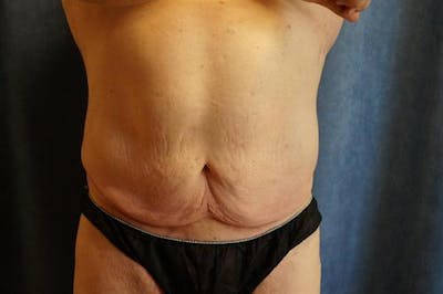 Plastic Surgery After Weight Loss Before & After Gallery - Patient 912687 - Image 1