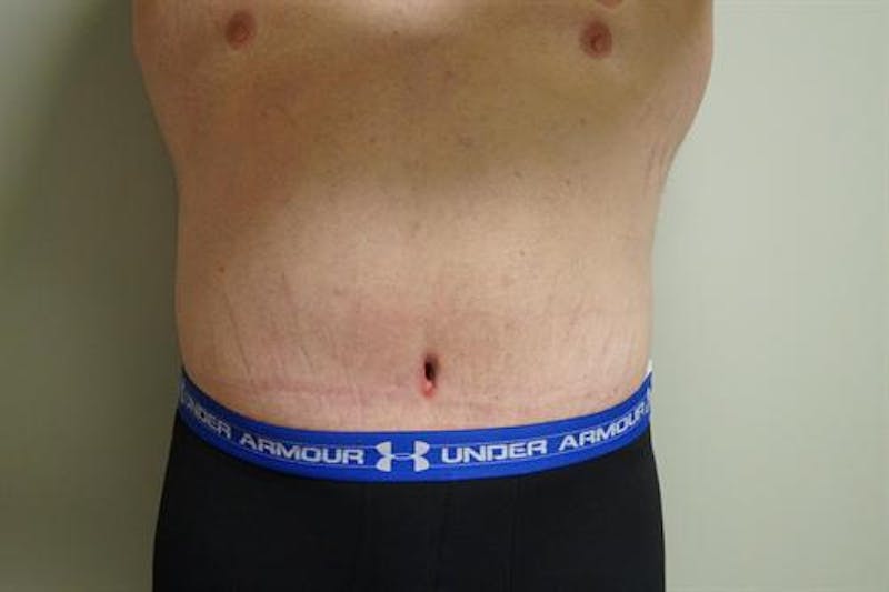 Plastic Surgery After Weight Loss Before & After Gallery - Patient 912687 - Image 2