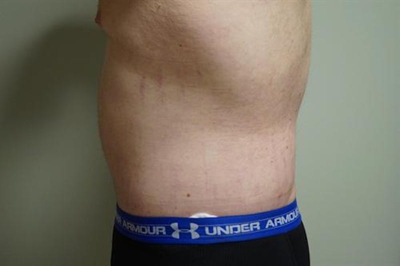Plastic Surgery After Weight Loss Before & After Gallery - Patient 912687 - Image 4