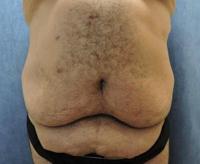 Plastic Surgery After Weight Loss Before & After Gallery - Patient 428637 - Image 1
