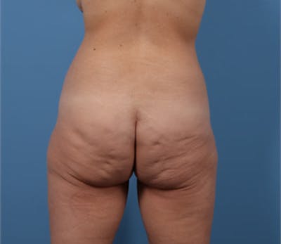 Body Lift with Buttock Augmentation Before & After Gallery - Patient 156887 - Image 1