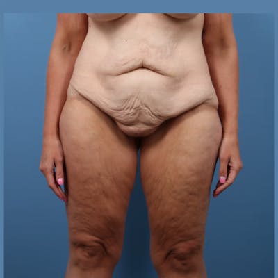 Body Lift with Buttock Augmentation Before & After Gallery - Patient 306635 - Image 1