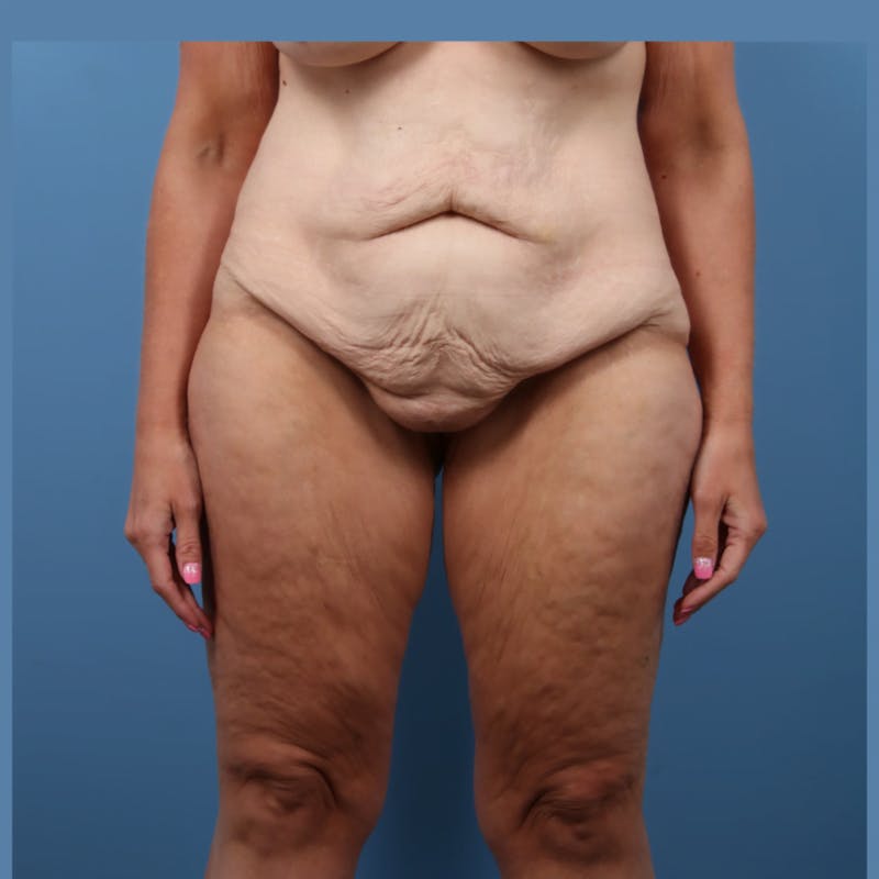 Body Lift with Buttock Augmentation Before & After Gallery - Patient 306635 - Image 1