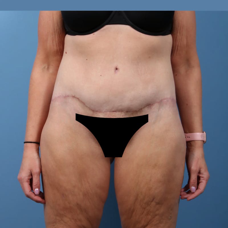Body Lift with Buttock Augmentation Before & After Gallery - Patient 306635 - Image 2