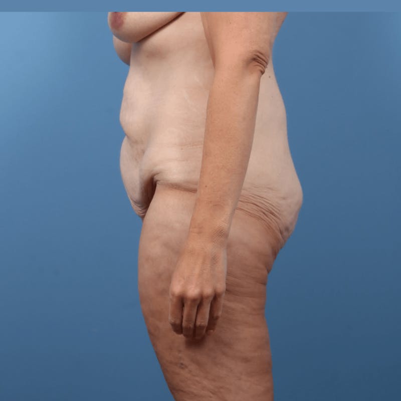 Body Lift with Buttock Augmentation Before & After Gallery - Patient 306635 - Image 3