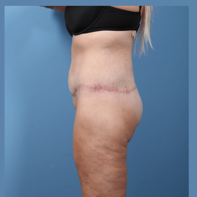 Body Lift with Buttock Augmentation Before & After Gallery - Patient 306635 - Image 4