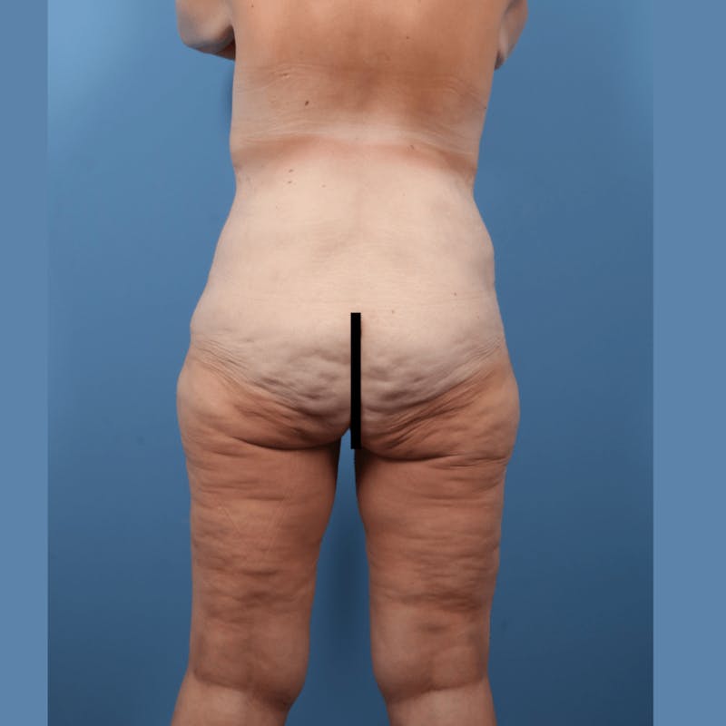 Body Lift with Buttock Augmentation Before & After Gallery - Patient 306635 - Image 5