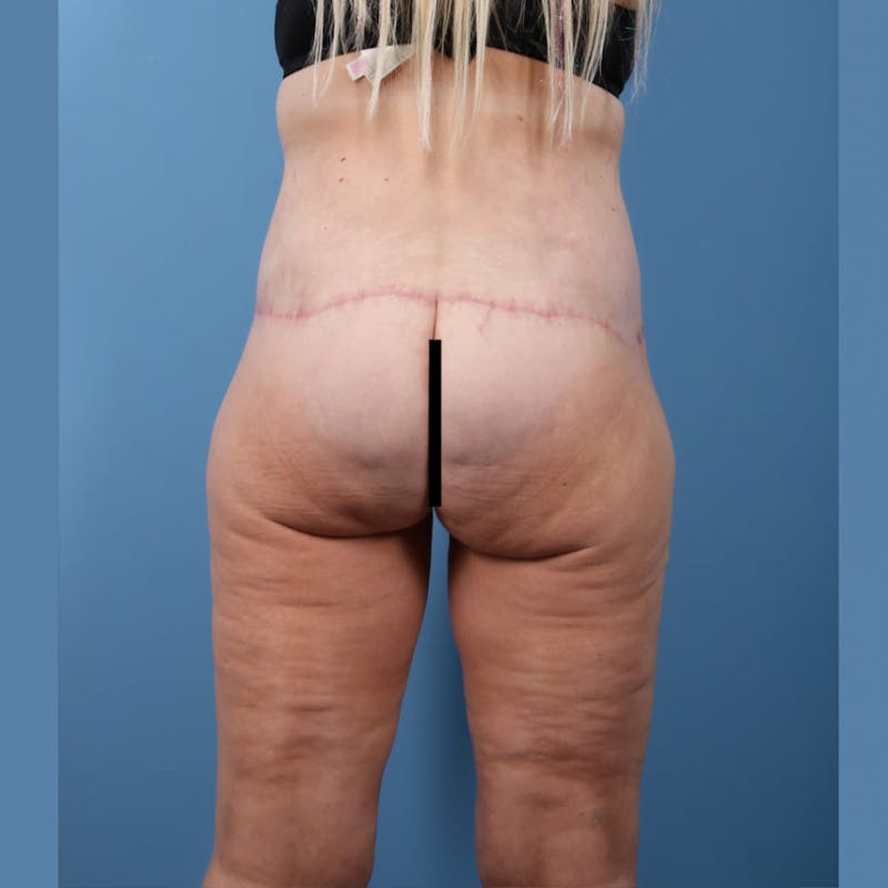 Body Lift with Buttock Augmentation Before & After Gallery - Patient 306635 - Image 6