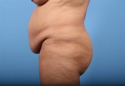 Body Lift with Buttock Augmentation Before & After Gallery - Patient 148929 - Image 1