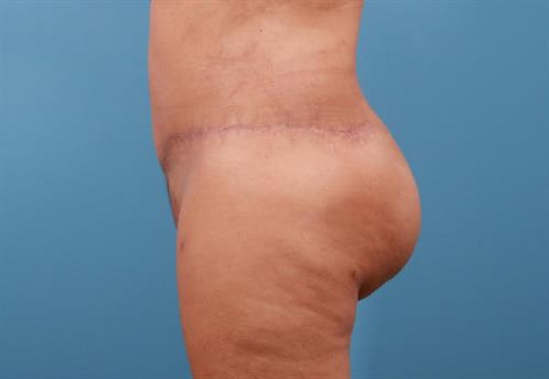 Body Lift with Buttock Augmentation Before & After Gallery - Patient 148929 - Image 2