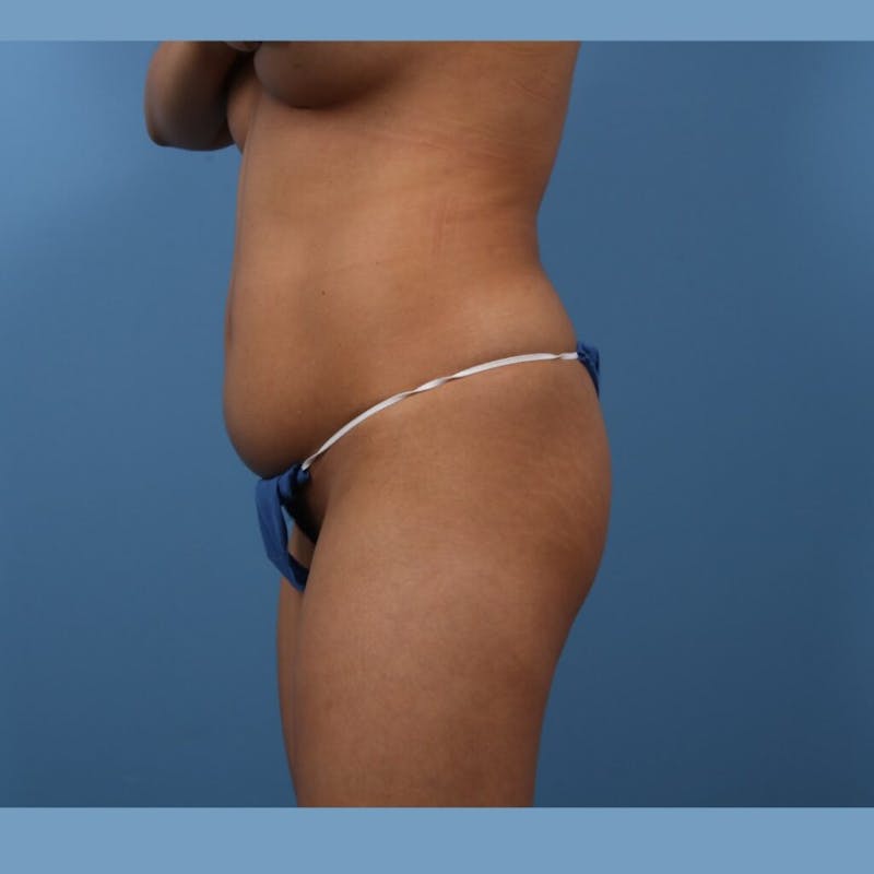 Brazilian Butt Lift (BBL) Before & After Gallery - Patient 366309 - Image 5