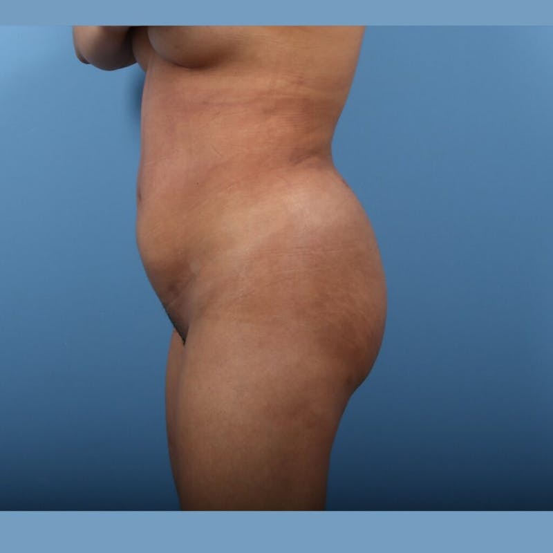 Brazilian Butt Lift (BBL) Before & After Gallery - Patient 366309 - Image 6