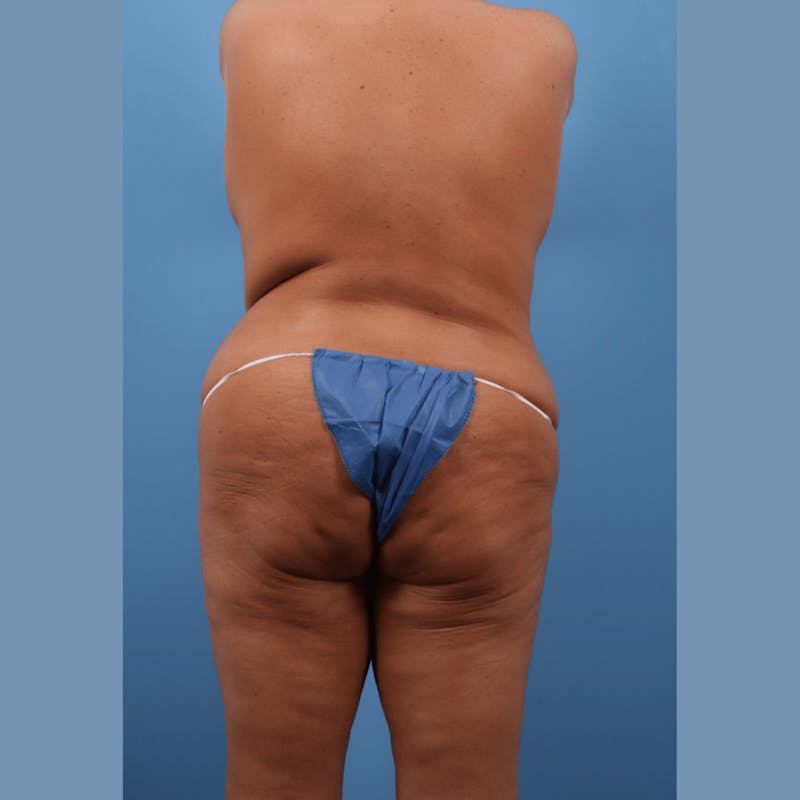 Brazilian Butt Lift (BBL) Before & After Gallery - Patient 127559 - Image 1