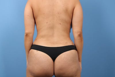 Brazilian Butt Lift (BBL) Before & After Gallery - Patient 189611 - Image 2