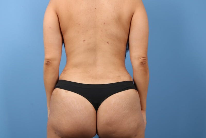 Brazilian Butt Lift (BBL) Before & After Gallery - Patient 189611 - Image 2